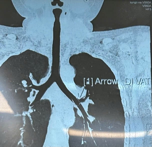 Hình ảnh CT Scan nghi ngờ có dị vật trong phế quản gốc trái. Ảnh BVCC