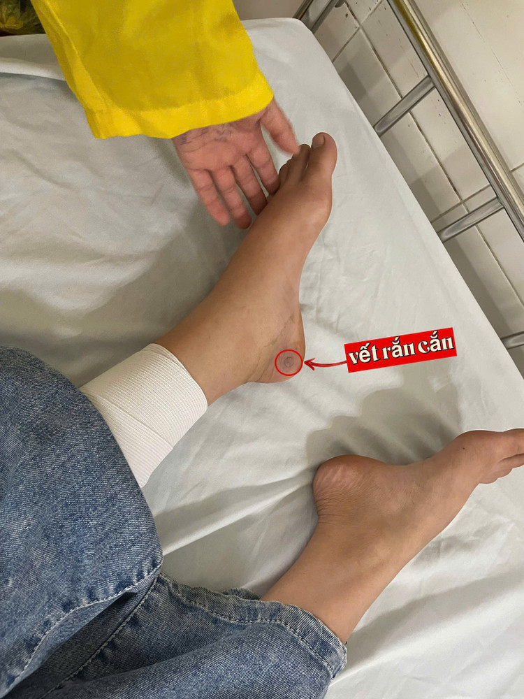 Vết rắn cắn của bệnh nhi. Ảnh BVCC