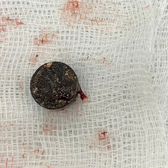 Thành công lấy dị vật ra khỏi mũi bé trai. Ảnh BVCC