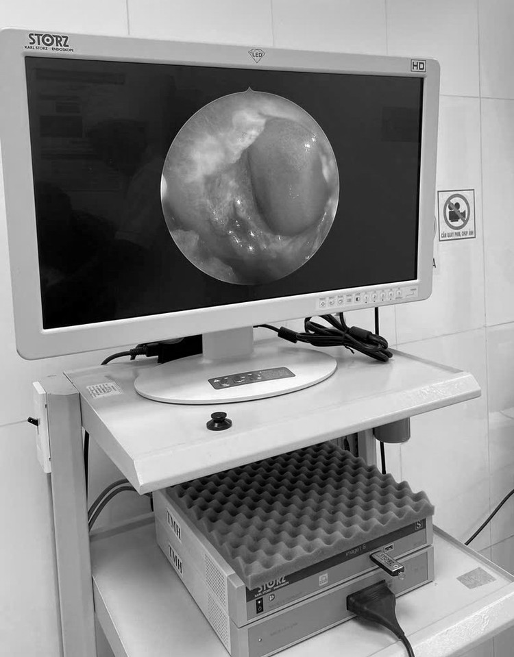 Hình ảnh nội soi cho thấy một dị vật nằm trong hốc mũi bên phải của bé gây viêm đường hô hấp. Ảnh BVCC