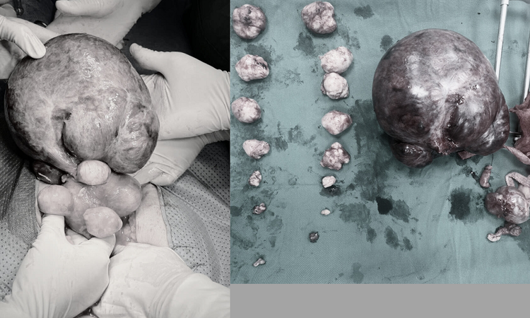 Khối U xơ cổ tử cung khổng lồ KT: 11x12cm cùng hơn 10 khối u xơ nhỏ khác. Ảnh BVCC