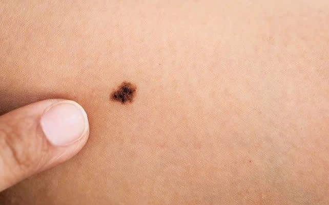 Hiện nay, tỷ lệ mắc bệnh ung thư tế bào hắc tố có xu hướng gia tăng. Ảnh minh họa
