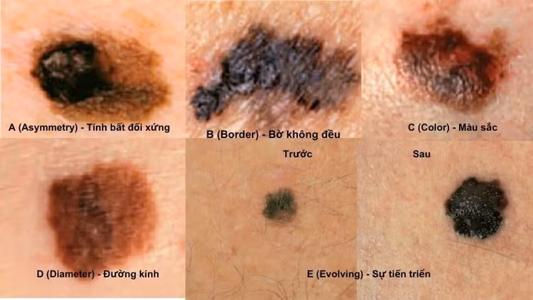 Ung thư tế bào hắc tố là nguyên nhân gây tử vong hàng đầu liên quan đến ung thư da. Ảnh minh họa