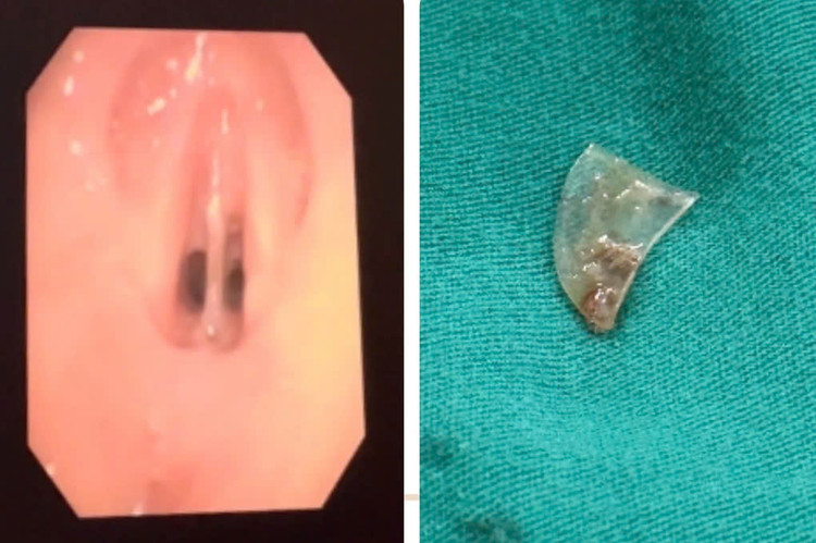 Mảnh nhựa cắm giữa thanh môn bé gái rất hiếm gặp. Ảnh BVCC