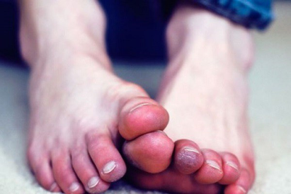 Mẹo phòng ngừa và hạn chế bệnh cước chân tay vào mùa đông