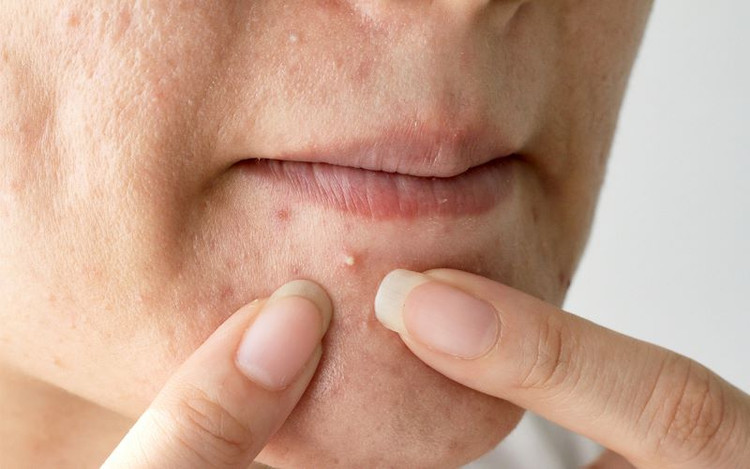 Cách nhận biết các loại mụn phổ biến trên da. Ảnh minh họa