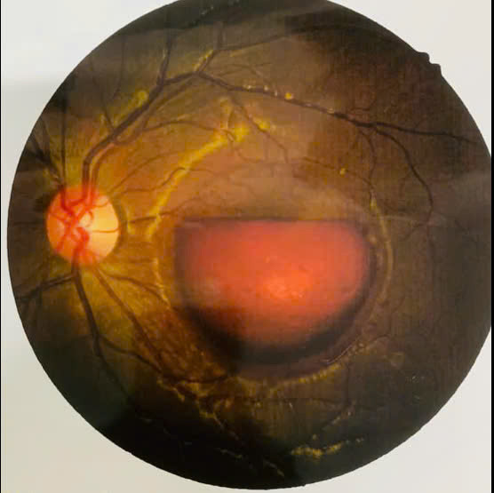 Hình ảnh nội soi mắt bệnh nhi. Ảnh BVCC