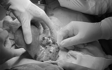 Phẫu thuật thành công cho bé gái 15 tuổi bị u buồng trứng xoắn. Ảnh Dân Việt