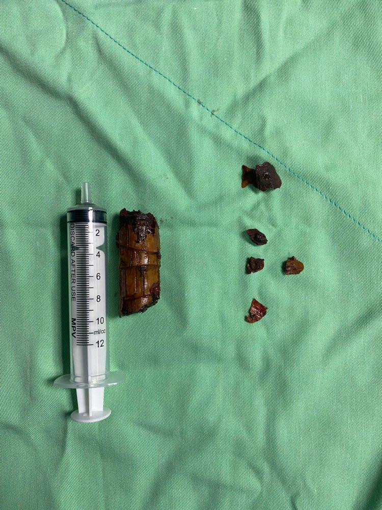 Dị vật là một khúc cây phát tài dài khoảng 5 cm. Ảnh BVCC