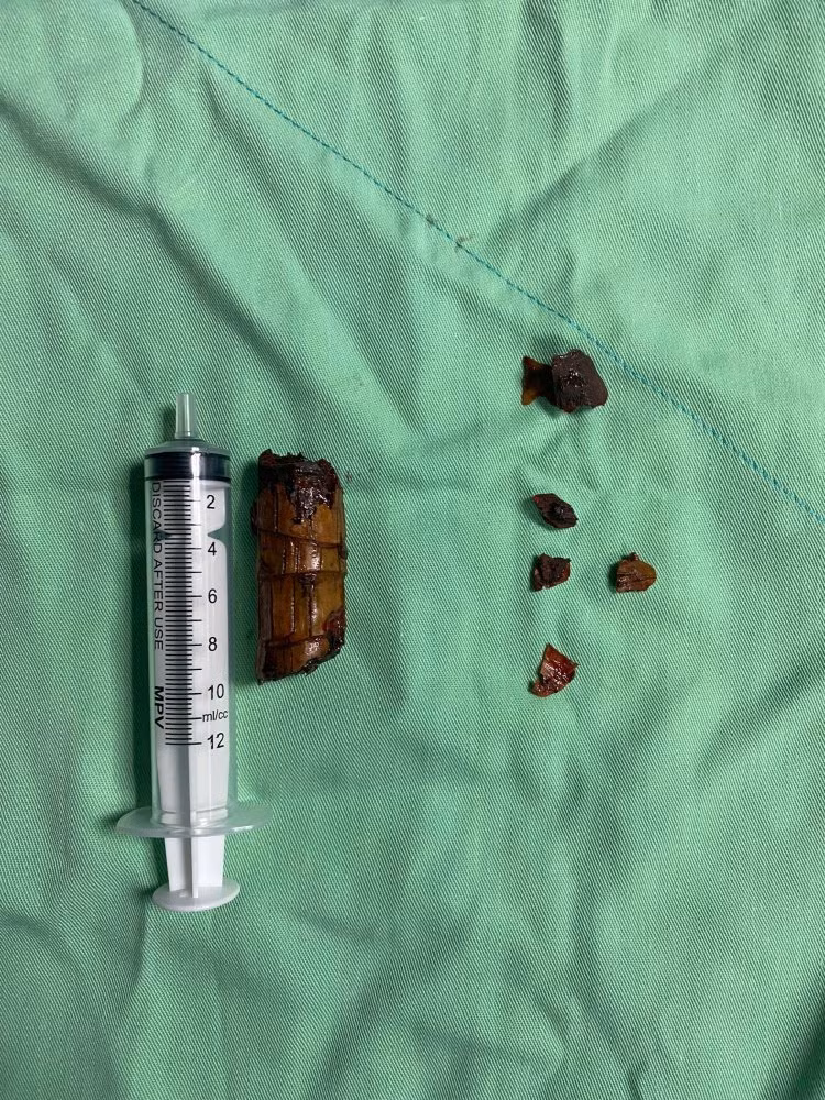 Dị vật là một khúc cây phát tài dài khoảng 5 cm. Ảnh BVCC