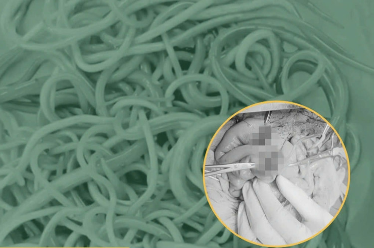 Hơn 100 con giun đũa lớn nhỏ đã gây tắc ruột, sốc nhiễm trùng ở bệnh nhi 2,5 tuổi. Ảnh BVCC