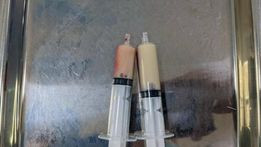 Mỡ máu của bệnh nhân tăng gấp 50 lần Ảnh: Trung tâm cung cấp