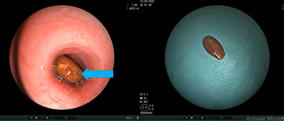 Nội soi ghi nhận dị vật là hạt dưa hấu gây bít tắc gần hết lòng khí quản đoạn bên dưới gần chỗ chia phế quản gốc. Ảnh BVCC