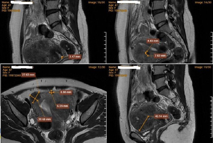 Hình ảnh chụp MRI cho thấy bệnh nhân mắc đa u xơ tử cung. Ảnh BVCC