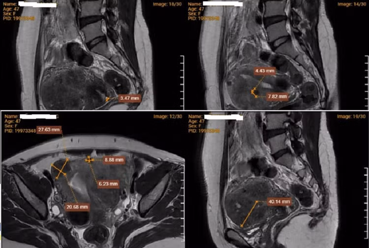 Hình ảnh chụp MRI cho thấy bệnh nhân mắc đa u xơ tử cung. Ảnh BVCC