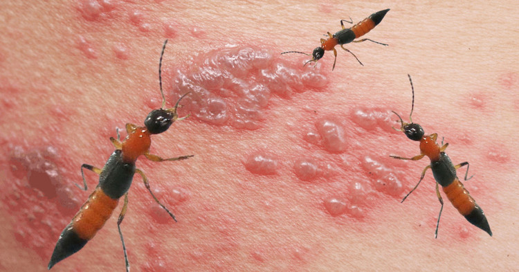 Biểu hiện viêm da tiếp xúc do kiến ba khoang gây ra. Ảnh minh họa