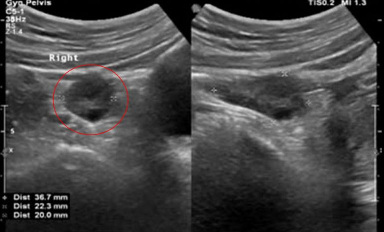 Kết quả siêu âm phát hiện khối u trong buồng trứng bệnh nhi. Ảnh BVCC