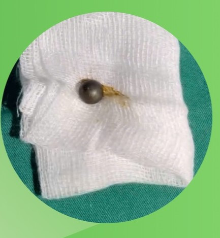 Dị vật được lấy ra từ trong mũi bé. Ảnh TTYT huyện Thanh Ba