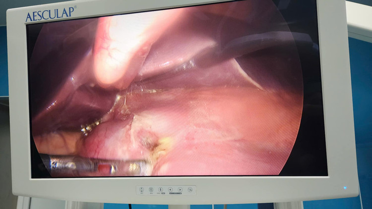 Hình ảnh lỗ thủng dạ dày của bệnh nhân. Ảnh TTYT huyện Đông Triều