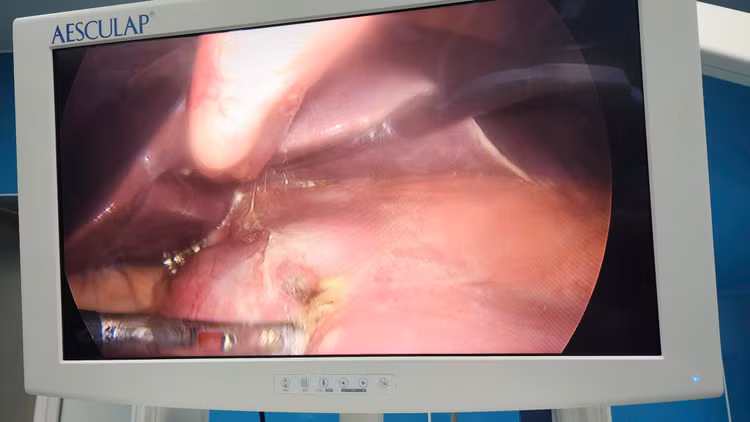 Hình ảnh lỗ thủng dạ dày của bệnh nhân. Ảnh TTYT huyện Đông Triều