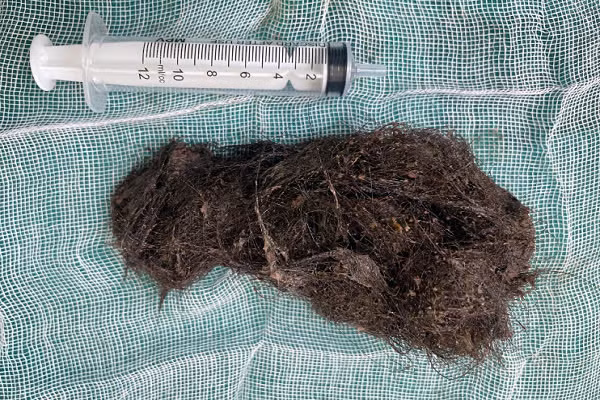 Búi tóc lớn có kích thước khoảng 8cm được lấy ra khỏi dạ dày của bệnh nhi. BVCC