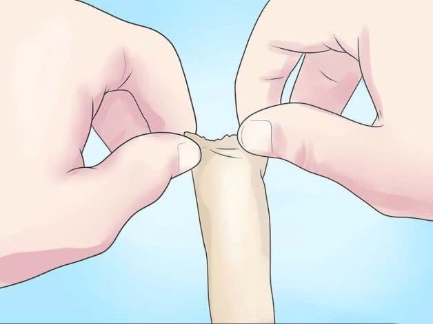 Chủ quan lộn bao quy đầu tại nhà, bé trai 5 tuổi nhập viện. Ảnh minh họa