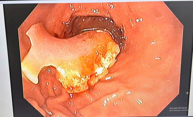 Dị vật là răng giả nằm sâu trong dạ dày bệnh nhân. Ảnh SK&amp;ĐS