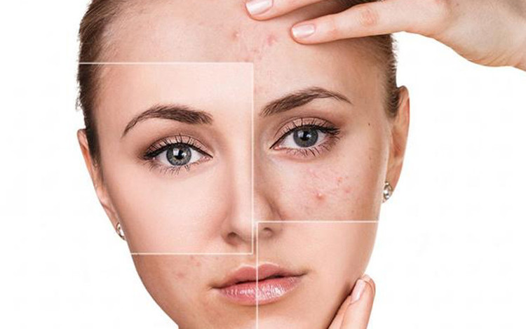 Mách bạn 5 cách làm mờ sẹo thâm, kích thích tái tạo tế bào da mới. Ảnh minh họa