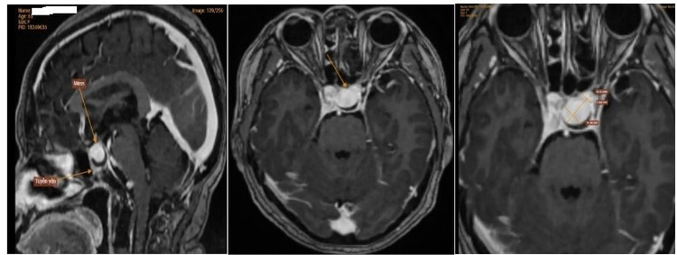 Nữ bệnh nhân T. có một túi phình kích thước lớn ở động mạch não. Ảnh BVCC
