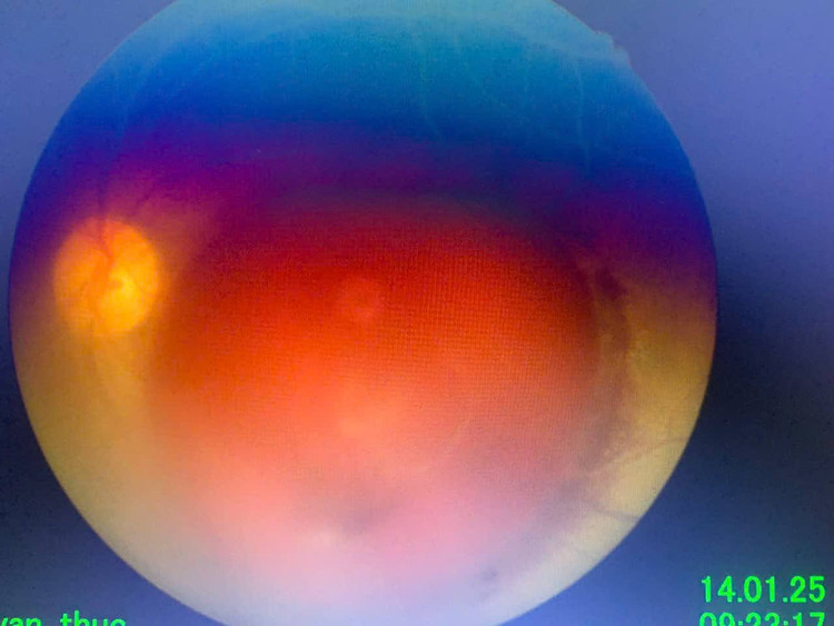 Bệnh nhân bị tổn thương mắt do đèn laser. Ảnh BVCC