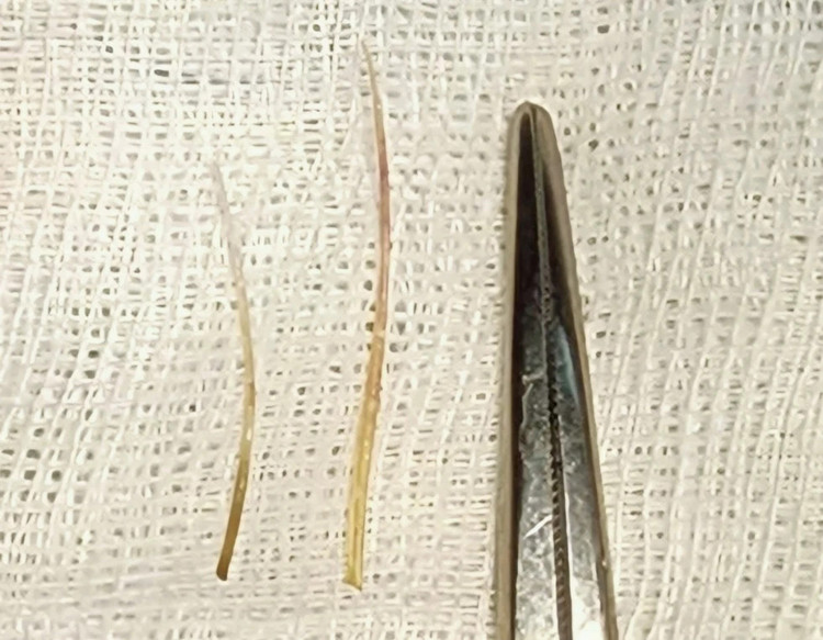 Hai mảnh xương cá được gắp ra khỏi tá tràng. Ảnh BVCC