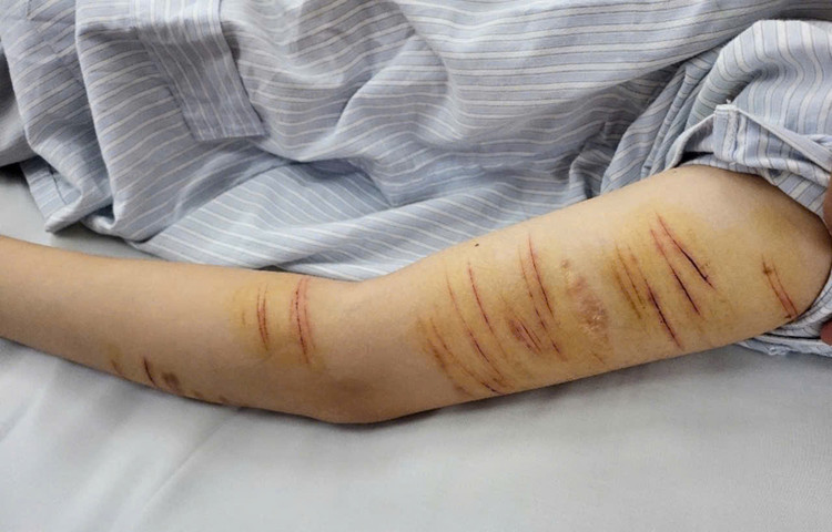 Bệnh nhân stress tự gây thương tích cho bản thân. Ảnh: BVCC