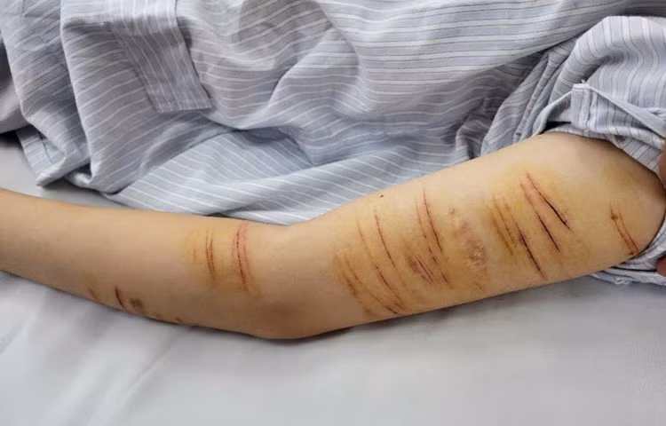 Bệnh nhân stress tự gây thương tích cho bản thân. Ảnh: BVCC Bệnh nhân stress tự gây thương tích cho bản thân. Ảnh: BVCC