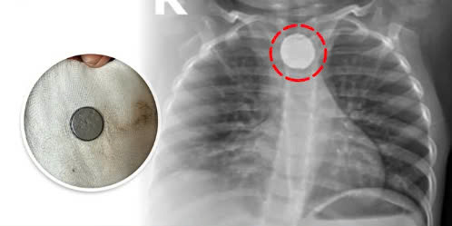 Dị vật pin cúc áo nằm trên thực quản của bệnh nhi. Ảnh BVCC