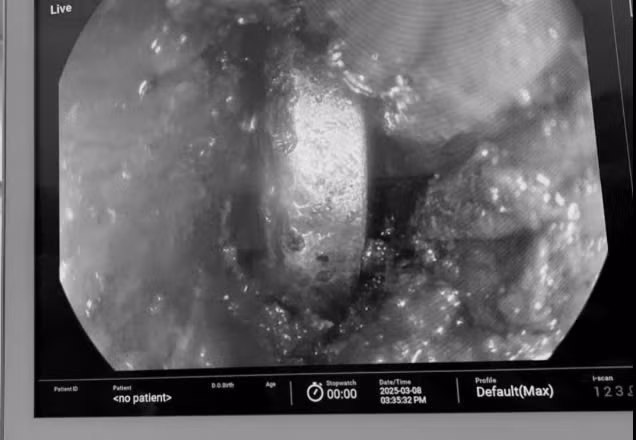 Nội soi phát hiện dị vật pin cúc áo trong thực quản bệnh nhi. Ảnh BVCC