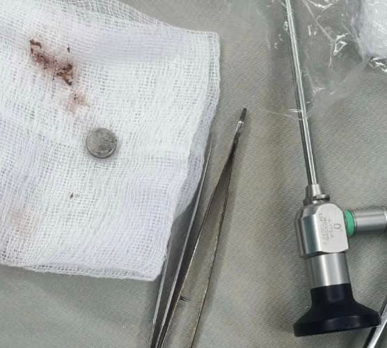 Cúc áo đã được lấy ra thành công. Ảnh BVCC