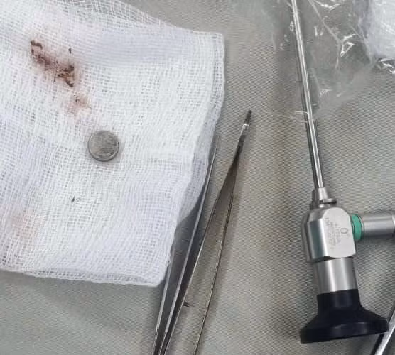 Cúc áo đã được lấy ra thành công. Ảnh BVCC