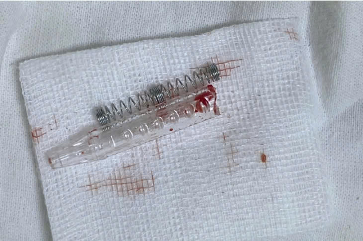 Dị vật là đầu bút bi còn lại mắc kẹt đã được lấy ra. Ảnh BVCC