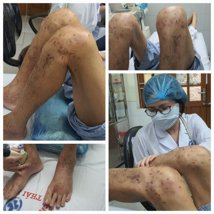 Những tai biến thường gặp do tự điều trị bệnh xương khớp. Ảnh BVCC