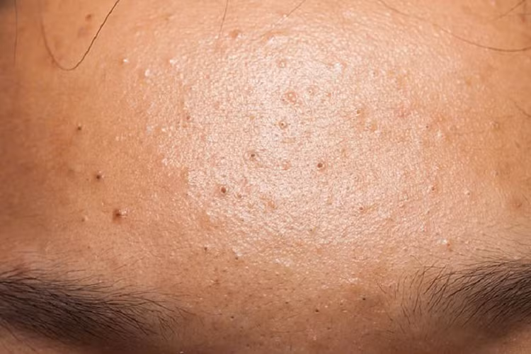 Lỗ chân lông bị tắc nghẽn, nổi mụn, cần làm gì để khắc phục? Ảnh minh họa