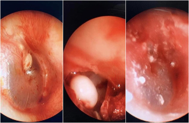Cholesteatoma trong tai của bệnh nhi được bóc tách ra ngoài. Ảnh: VTVNews