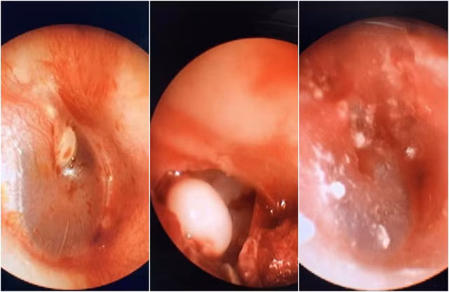 Cholesteatoma trong tai của bệnh nhi được bóc tách ra ngoài. Ảnh: VTVNews Cholesteatoma trong tai của bệnh nhi được bóc tách ra ngoài. Ảnh: VTVNews