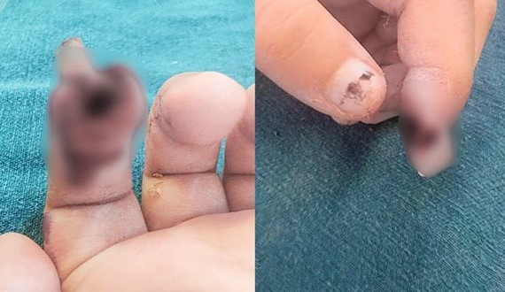 Tình trạng ngón tay trẻ thời điểm nhập viện. Ảnh BVCC