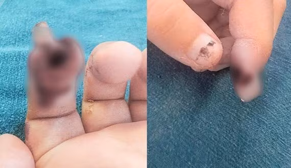 Tình trạng ngón tay trẻ thời điểm nhập viện. Ảnh BVCC