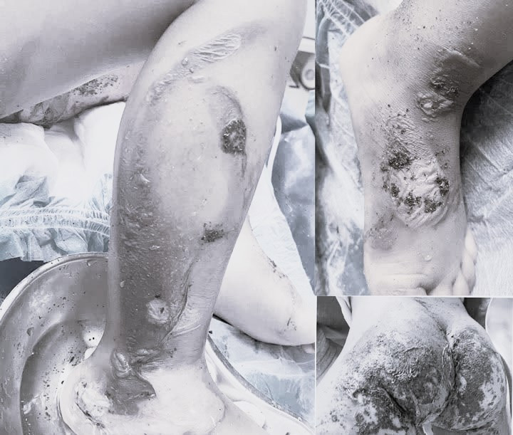 Hình ảnh tổn thương của bệnh nhi khi nhập viện. Ảnh BVCC