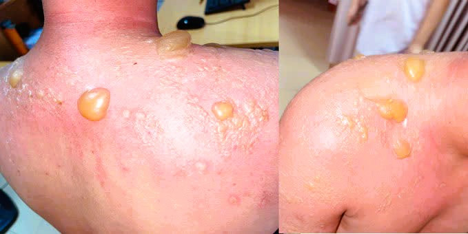 Tự ý tắm bằng một số loại lá cây, người bệnh xuất hiện nhiều nốt phỏng dạ kèm theo đau rát. Ảnh BVCC