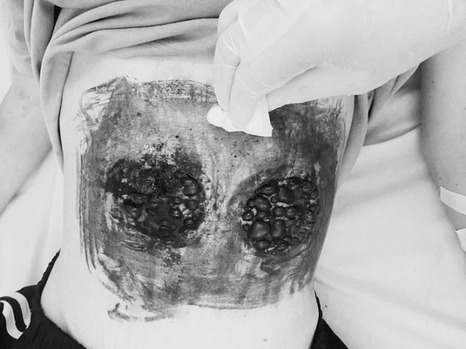 Úp bát nóng lên bụng chữa ung thư máu, nam thanh niên nguy kịch. Ảnh baogiaothong