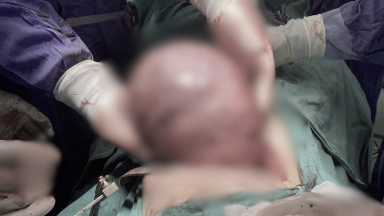 Hình ảnh khối u sau khi được phẫu thuật. Ảnh SK&amp;ĐS