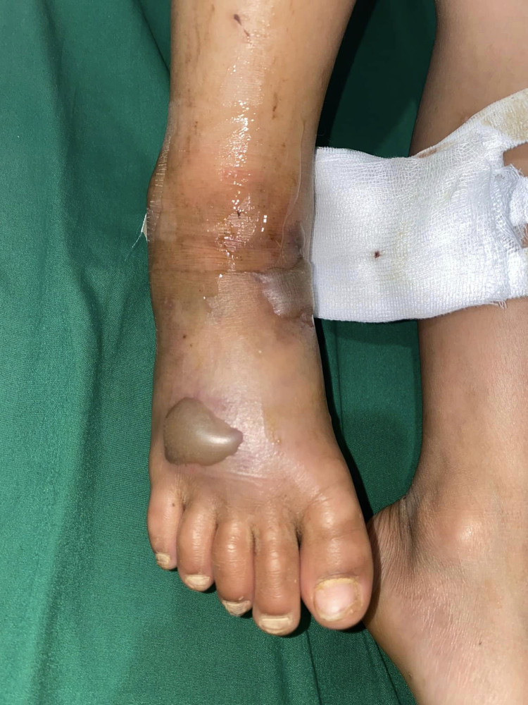 Chân bệnh nhân nhi bị rắn độc cắn. Ảnh Vietnamnet
