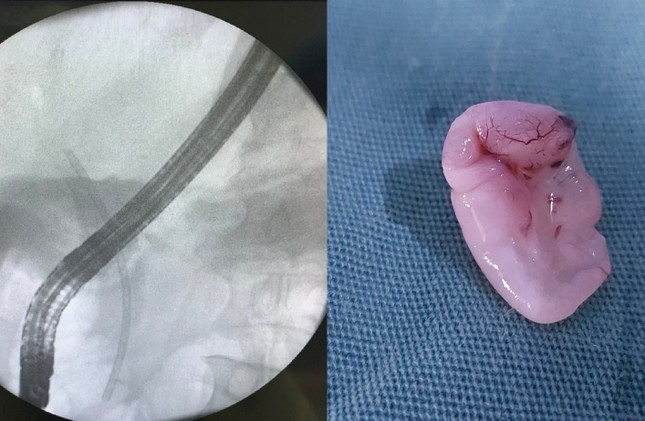 Sán lá gan có kích thước lớn trong ống mật chủ của bệnh nhân được bác sĩ thực hiện nội soi gắp ra ngoài. Ảnh baotienphong